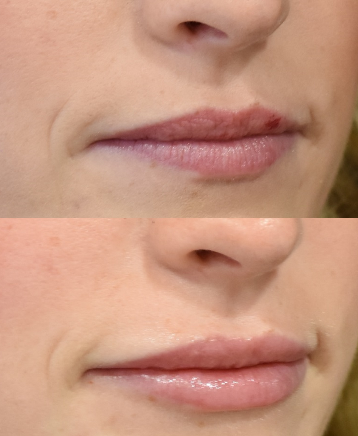 Lip Filler Before and After in Cincinnati, Ohio