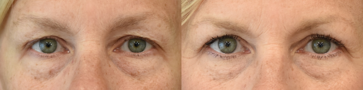 Upper Blepharoplasty Before and After_Horizontal.png