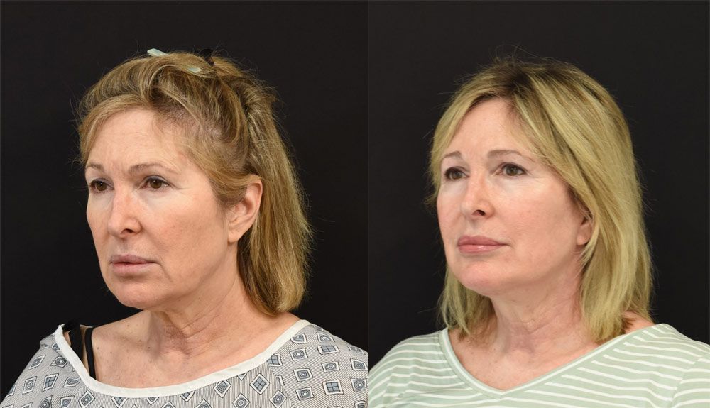 Cincinnati deep plane facelift, Cincinnati brow lift, Cincinnati neck lift recipient before & after photos Cincinnati deep plane facelift, Cincinnati brow lift, Cincinnati neck lift recipient before & after photos
