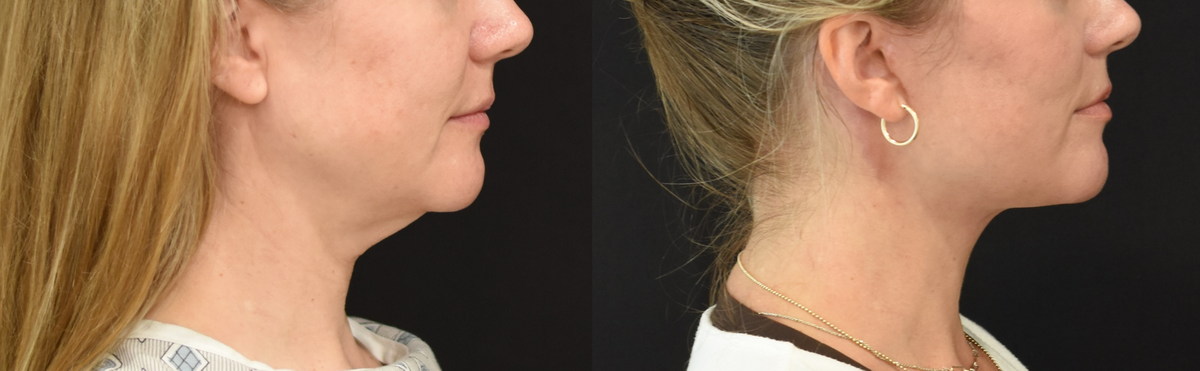 Facelift, Neck Lift Before & After in Cincinnati, Ohio