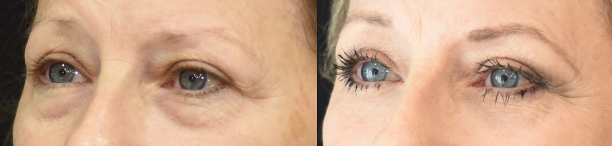 Female Lower Eyelid (Blepharoplasty) Surgery Before and After in Cincinnati, Ohio