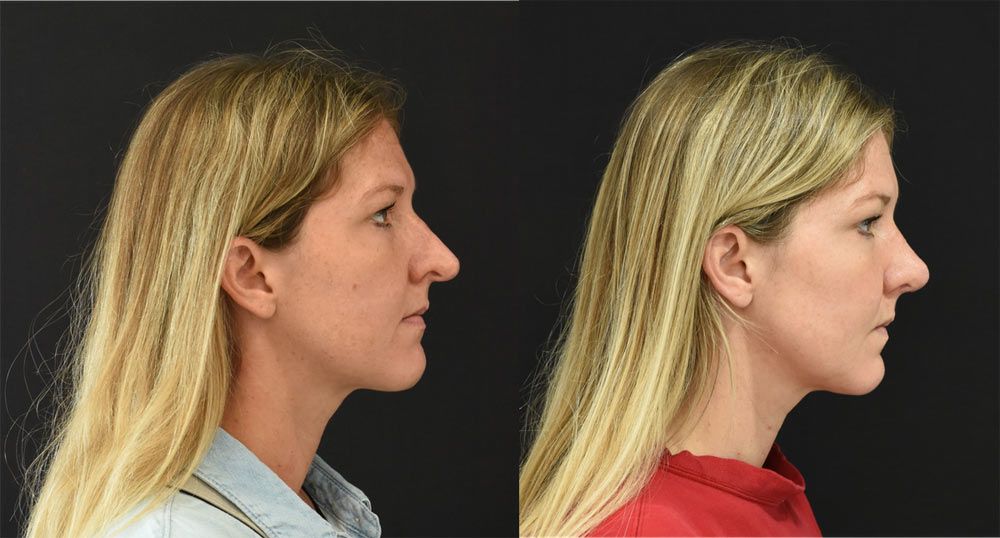 Cincinnati Revision Rhinoplasty Before and After - Right - Optimized
