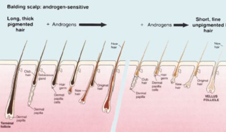 Diagram of Effects of Androgens on Balding Scalp Hair Follicles