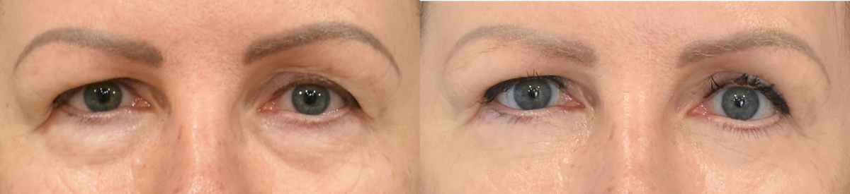 Lateral temporal brow lift, upper blepharoplasty, and lower blepharoplasty recipient before & after photo