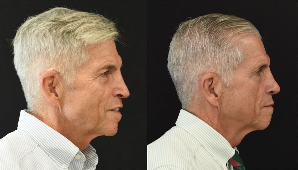 Cincinnati Revision Rhinoplasty Before & After - Optimized