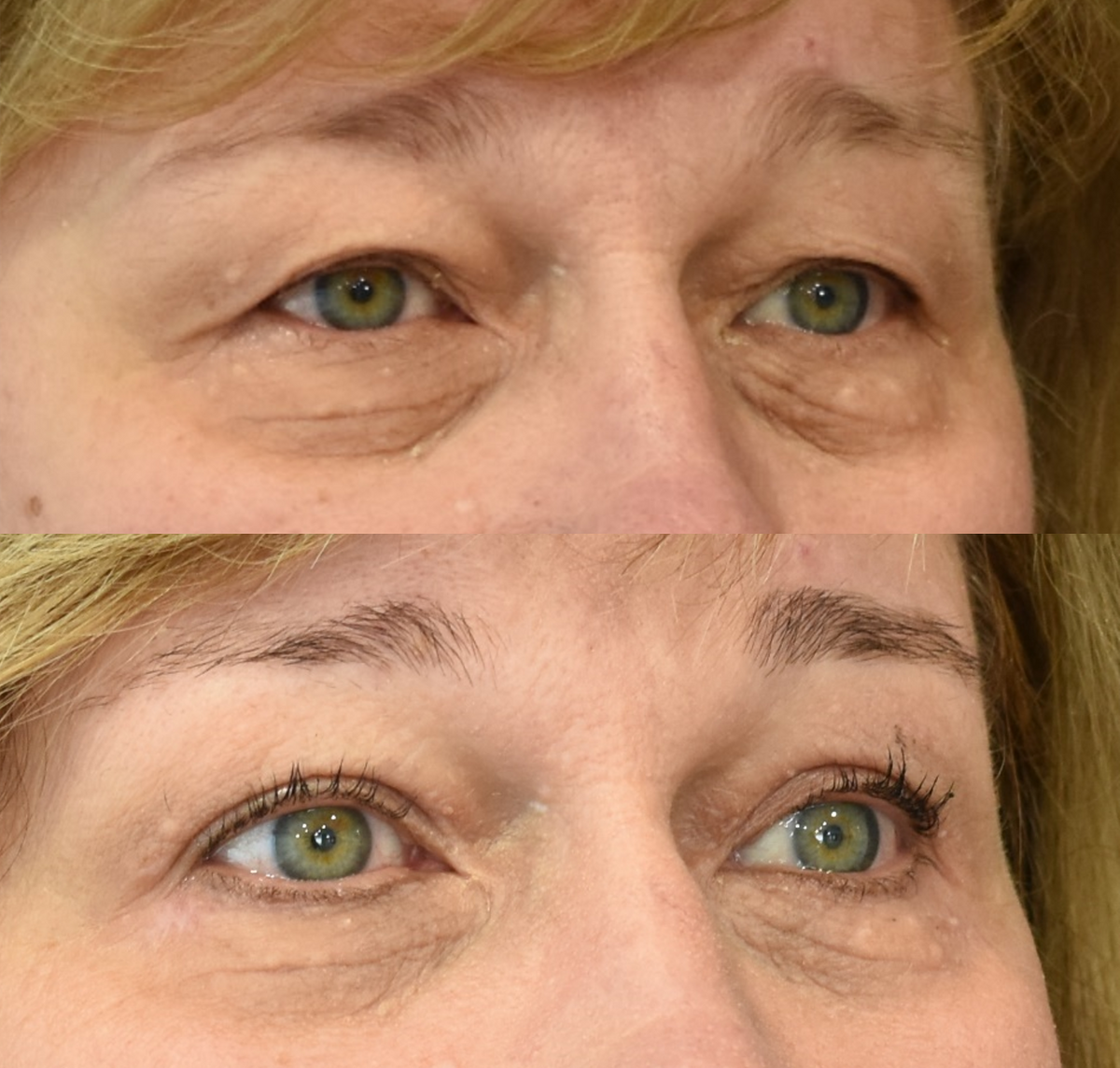 Upper Eyelid Surgery (Blepharoplasty) and Lower Eyelid Surgery (Blepharoplasty) Before & After in Cincinnati, Ohio