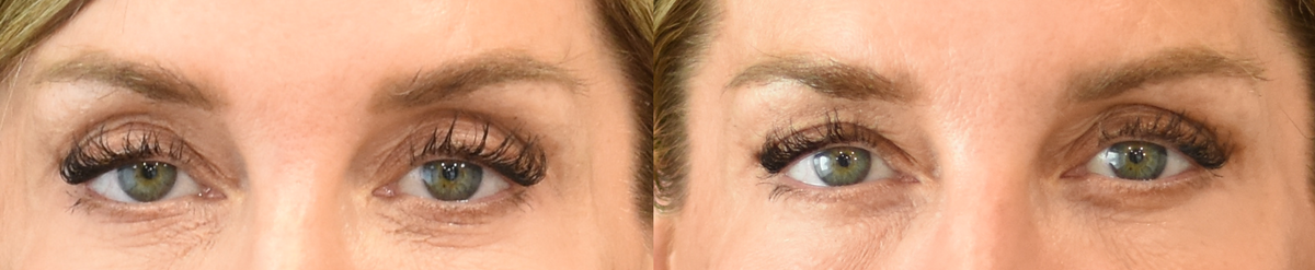 Lower eyelid (blepharoplasty) surgery before & after image in Cincinnati, Ohio