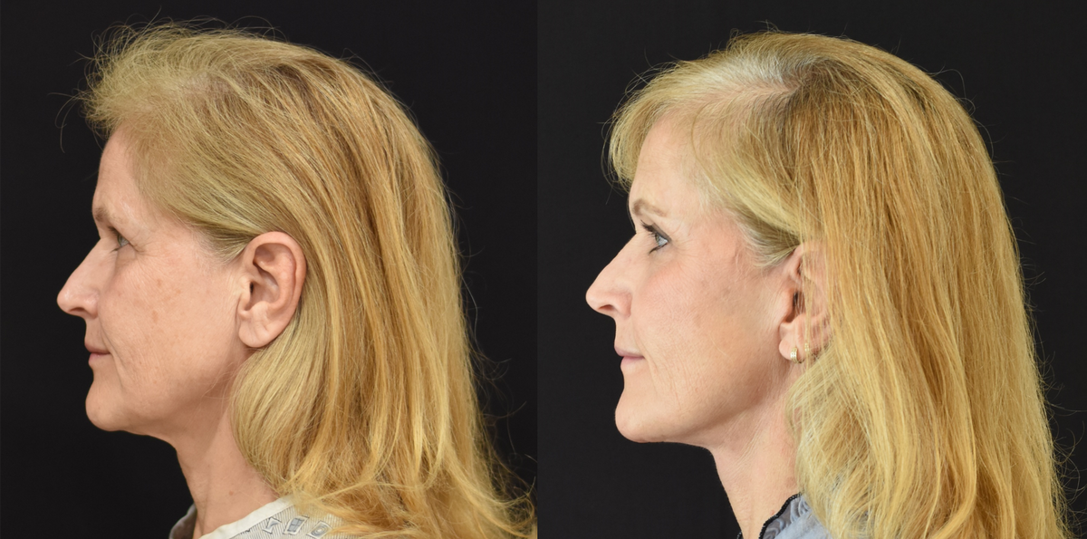 Facelift, Neck Lift, Brow Lift, Upper Eyelid (Blepharoplasty) Surgery, Lower Eyelid Skin Pinch Procedure Before & After in Cincinnati, Ohio