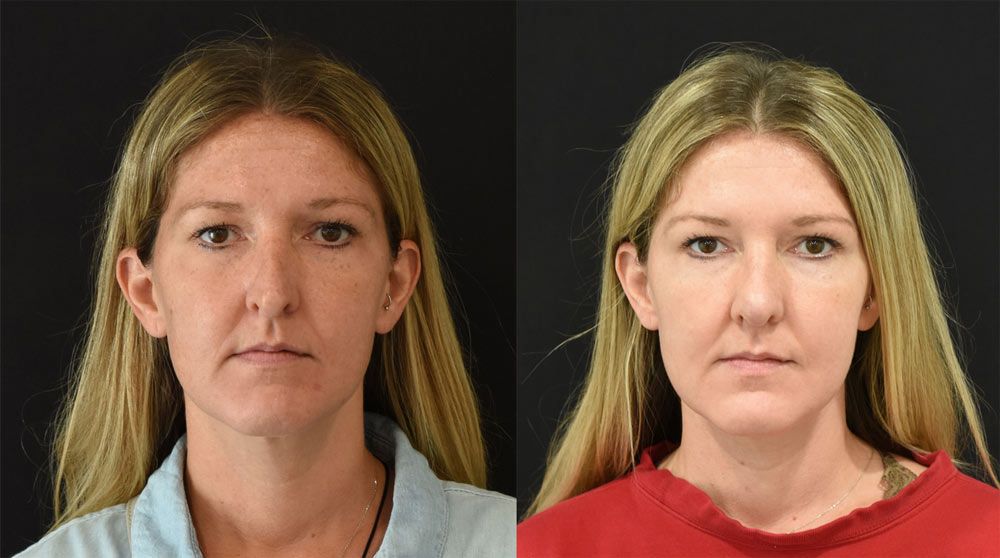 Cincinnati Revision Rhinoplasty Before and After - Front - Optimized