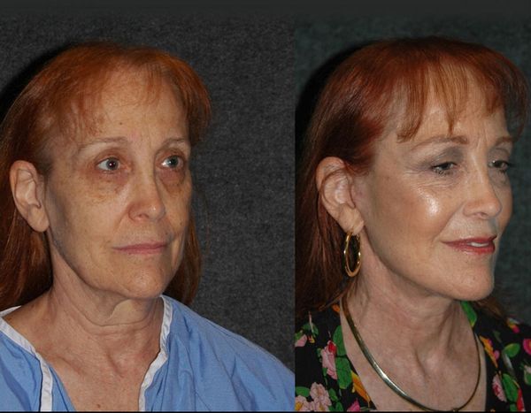 Cincinnati Extended Deep Plane Facelift and Cincinnati Neck Lift