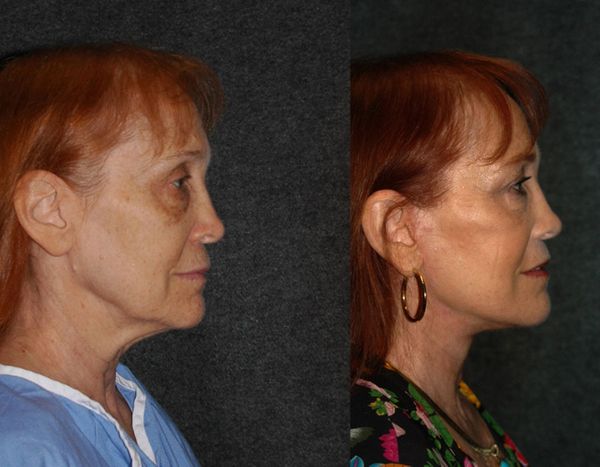 Cincinnati Extended Deep Plane Facelift and Cincinnati Neck Lift