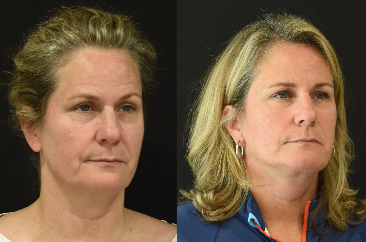  Facelift and Neck Lift in Cincinnati Before and After