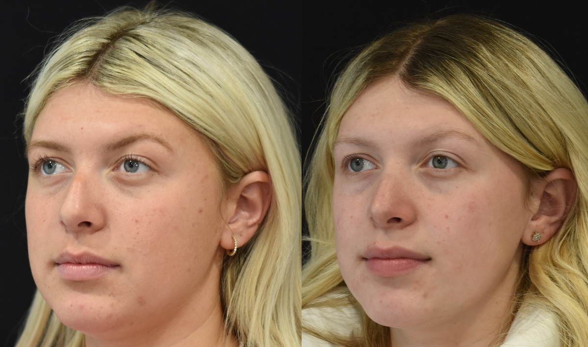 Rhinoplasty Before & After in Cincinnati, Ohio