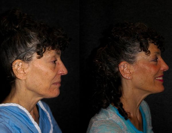 Cincinnati Rhinoplasty