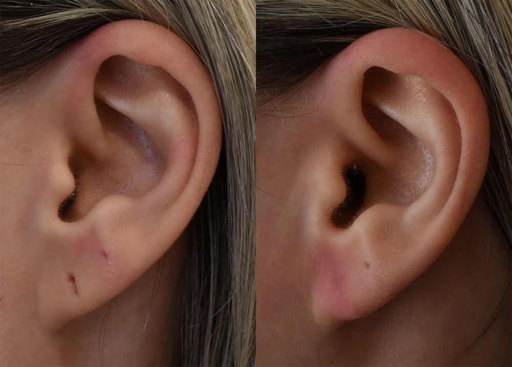 Cincinnati Earlobe Repair