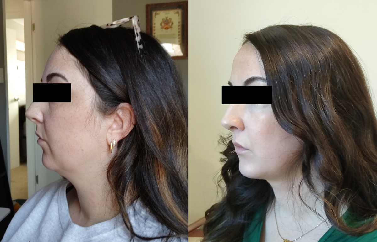 Chin Implant and Neck Liposuction Before & After in Cincinnati, Ohio