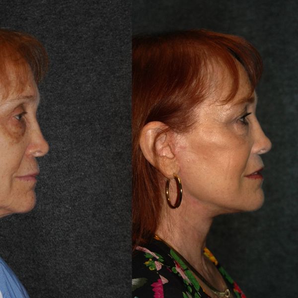 Before and after a facelift along the jawline.