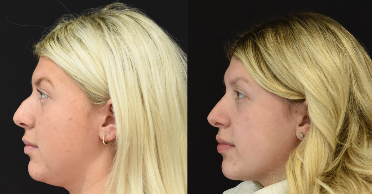 Rhinoplasty Before & After in Cincinnati, Ohio