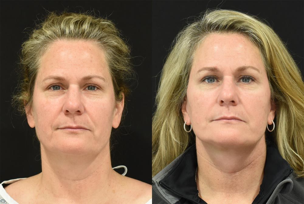 Cincinnati Brow Lift, Extended Deep Plane Facelift, and Neck Lift Before and After - Front - Optimized