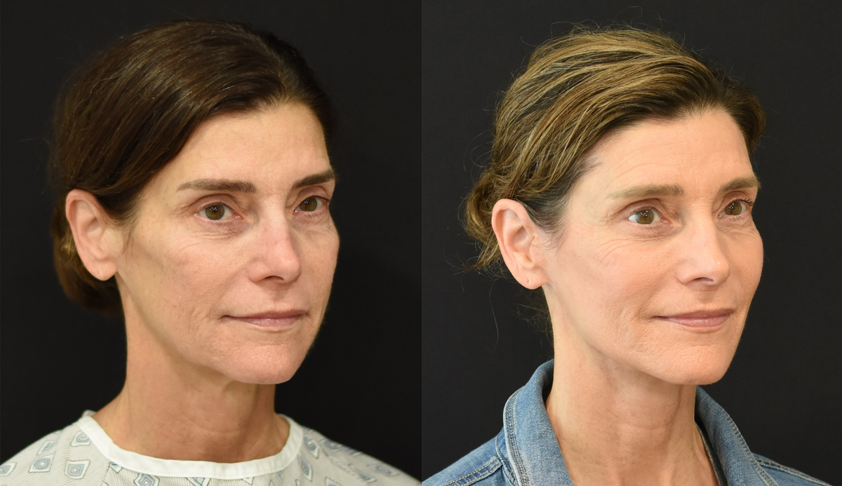 Facelift, Neck Lift, Brow Lift, and Laser Resurfacing Before and After in Cincinnati, Ohio