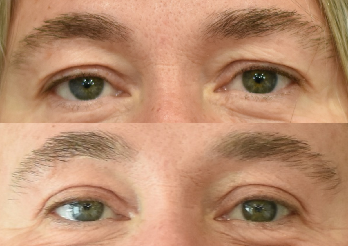 Upper eyelid (blepharoplasty) surgery before & after image in Cincinnati, Ohio