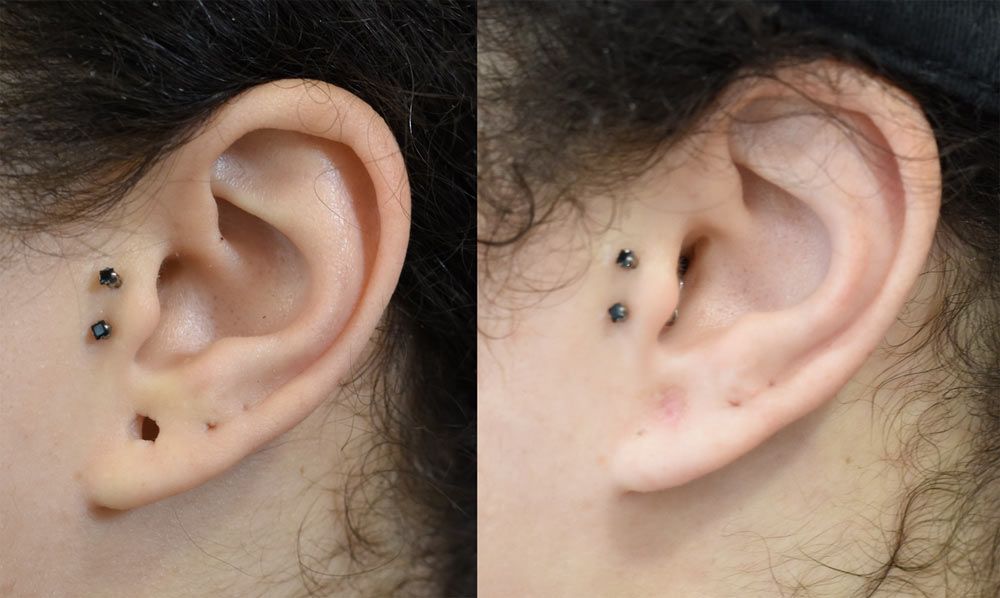 Earlobe Repair in Cincinnati 