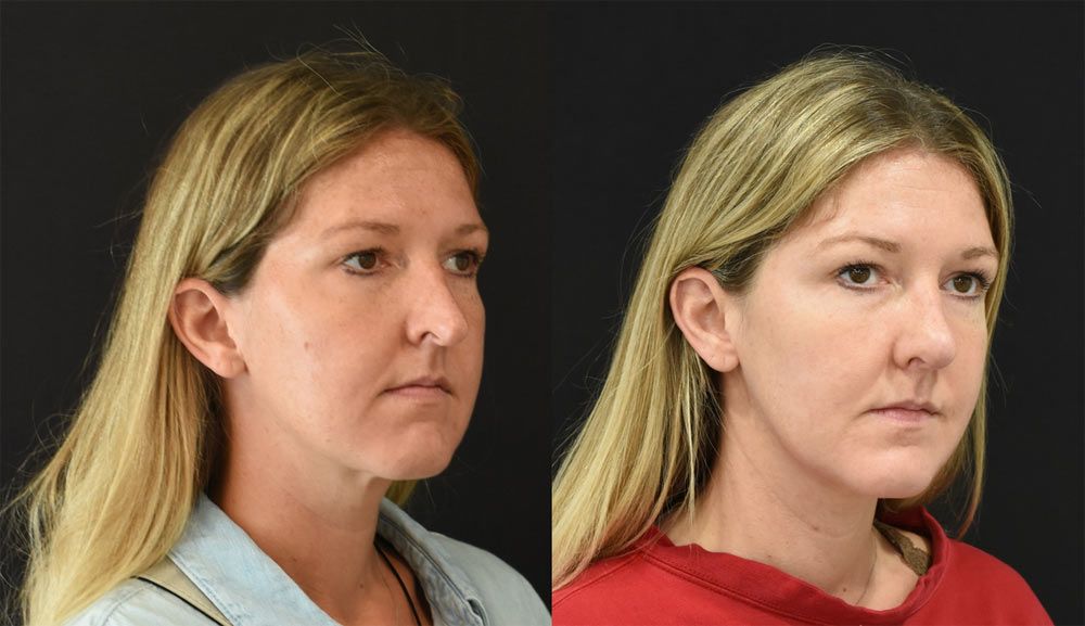 Cincinnati Revision Rhinoplasty Before and After - Three Quarter Right - Optimized