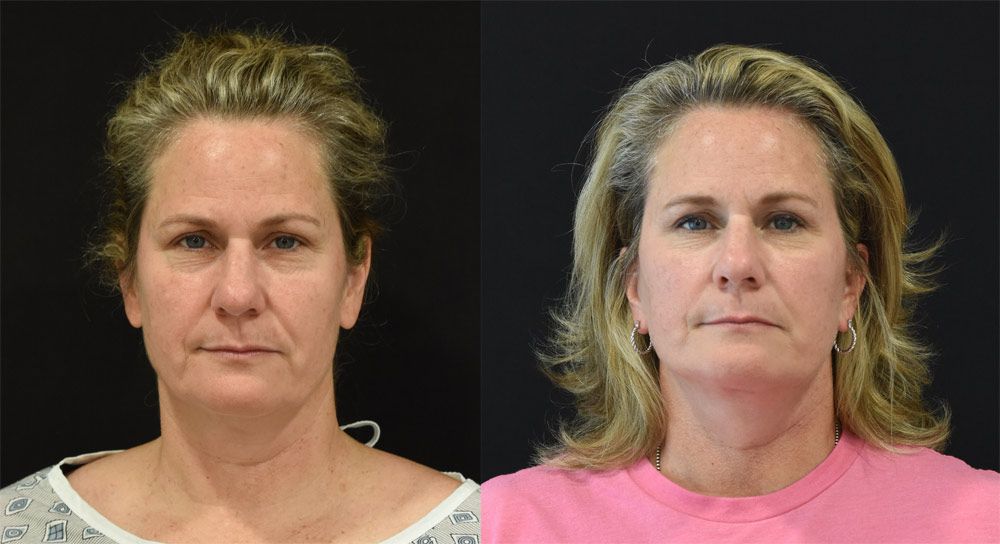Facelift, neck lift, and lateral temporal brow lift recipient before & after image