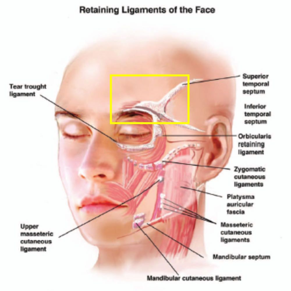Lateral Temporal Lift Ligaments