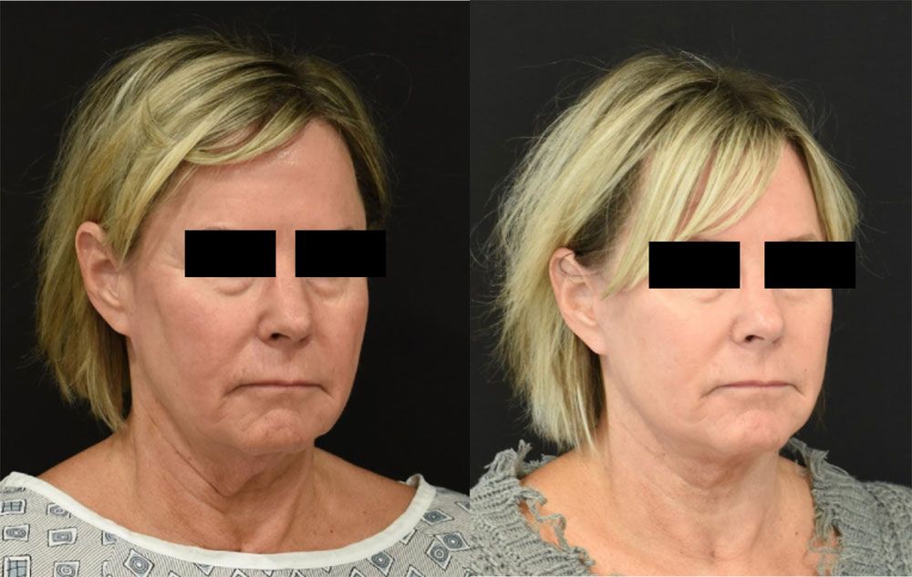 Facelift and Neck Lift in Cincinnati Before and After