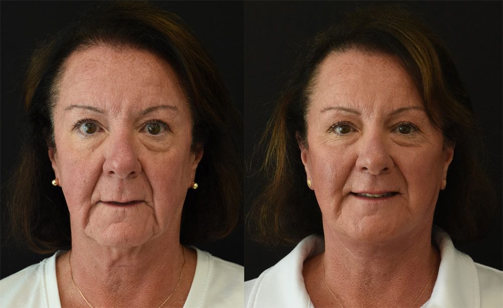 Patient that had a Facelift, Neck-Lift, and Lip-Lift In Cincinnati Patient that had a Facelift, Neck-Lift, and Lip-Lift In Cincinnati