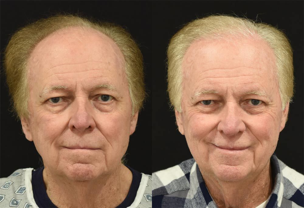 Hair Restoration Patient in Cincinnati