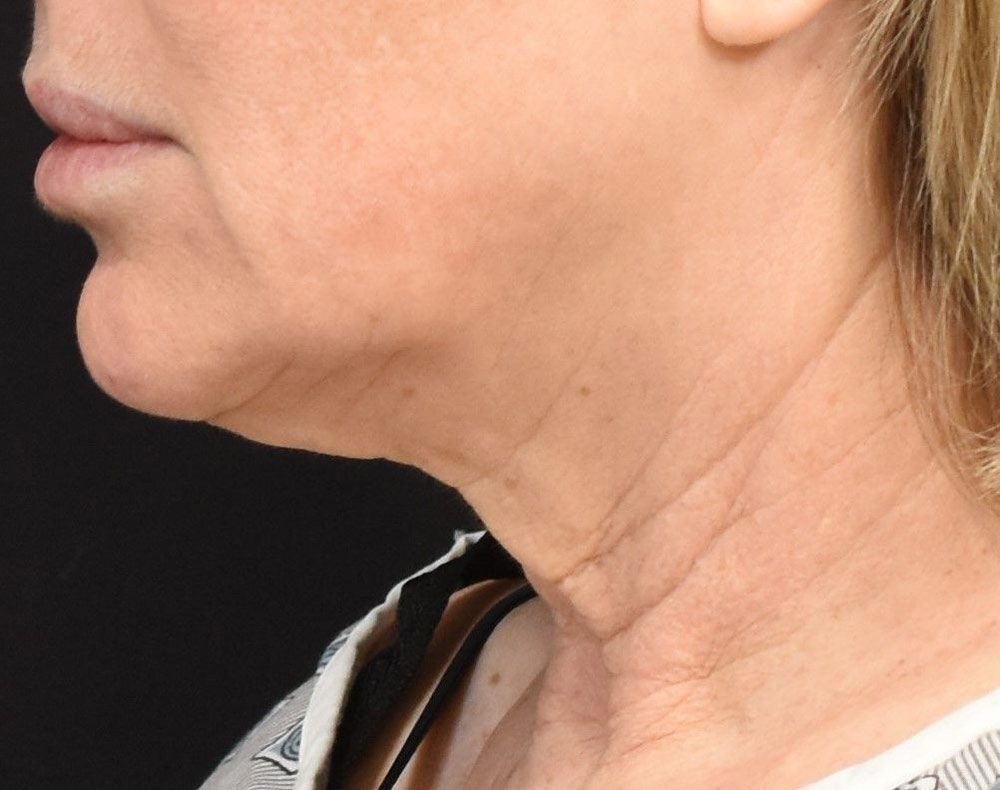 Patient With Loose Neck Skin