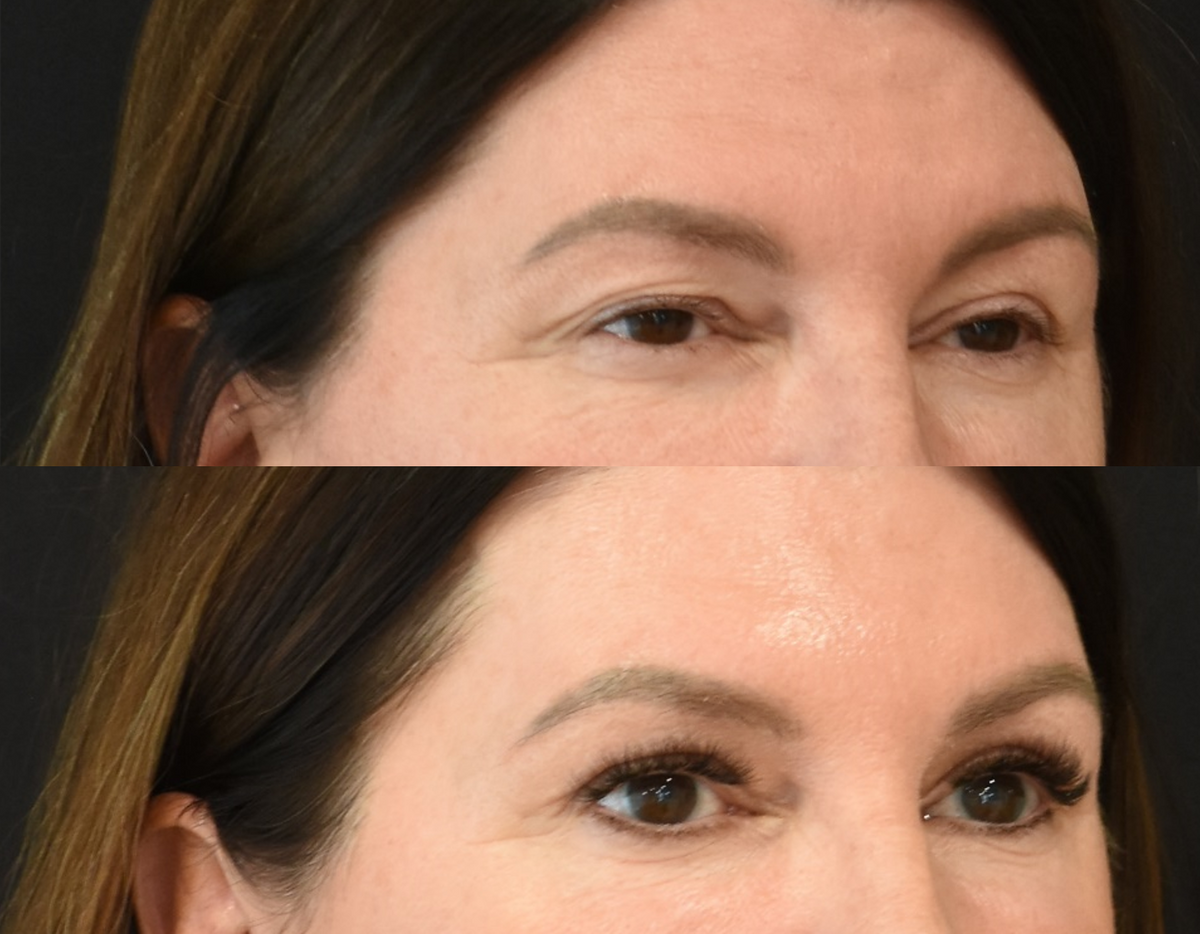 Brow Lift, Upper Eyelid Surgery (Blepharoplasty) Before & After in Cincinnati, Ohio