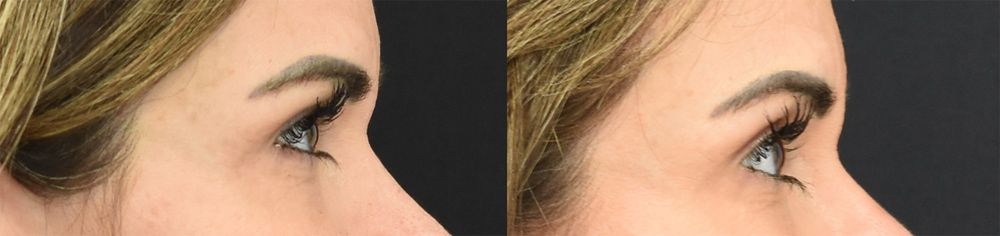 Lateral Temporal Lift (Cincinnati Brow Lift) Before and After