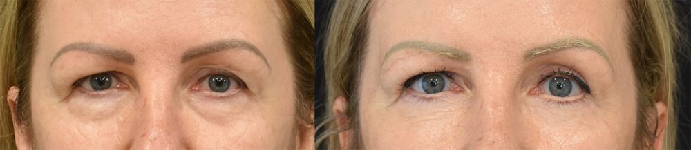 Cincinnati Eyelid Surgery and Brow Lift Before and After - Front - Optimized