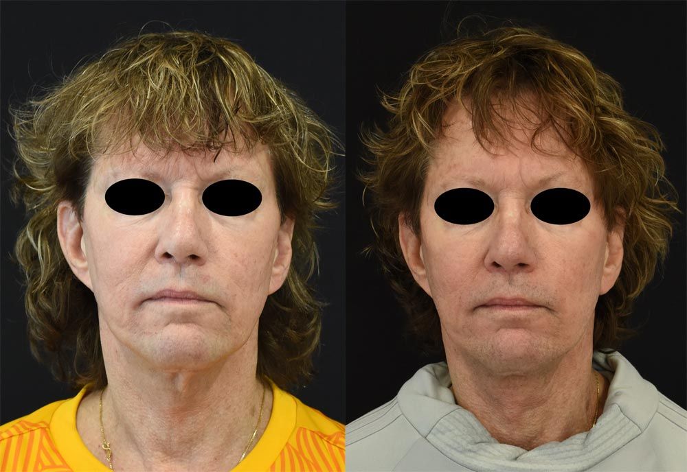 Cincinnati Revision, Neck Lift, Extended Deep Plane Facelift Before and After - Front - Optimized
