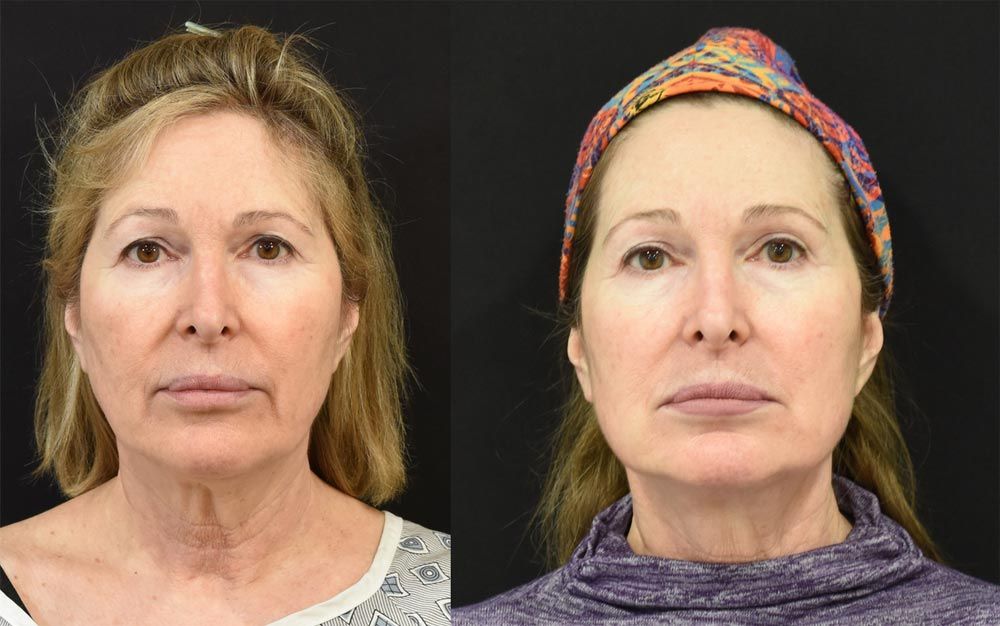 Cincinnati Extended Deep PLane Facelift, Neck Lift, Brow Lift, Eyelid Surgery Before and After - Front - Optimized