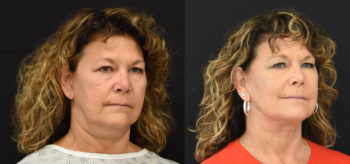Facelift, neck lift, CO2 laser, and nano-fat grafting before & after in Cincinnati, Ohio