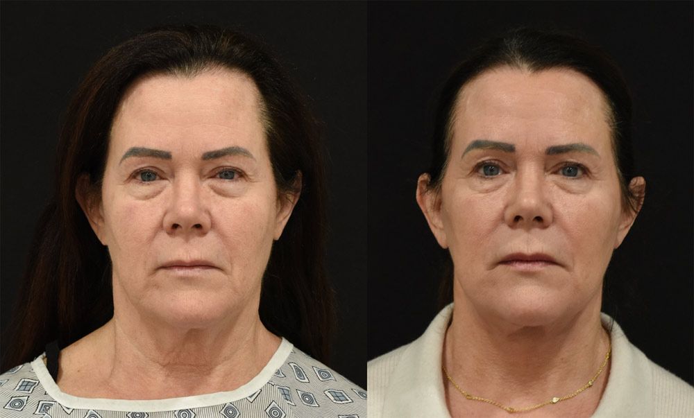 Cincinnati Extended Deep Plane Facelift, Neck Lift, Brow Lift Before and After - Front - Optimized
