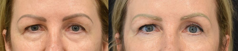 Lateral temporal brow lift, upper blepharoplasty, and lower blepharoplasty recipient before & after photo (Optimized)