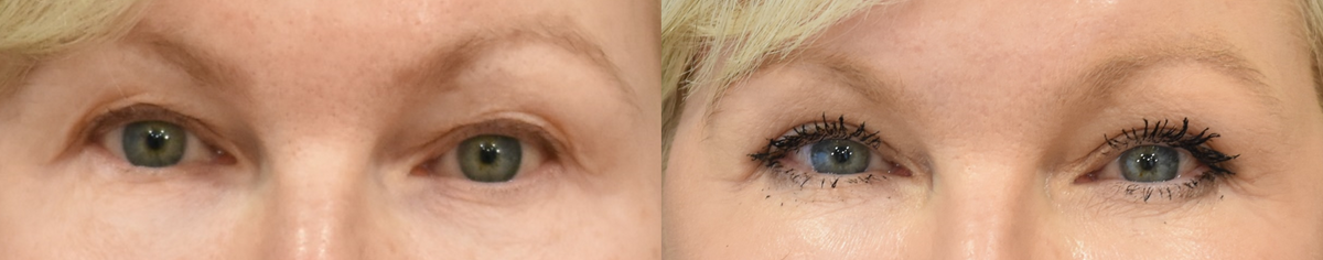 Upper Eyelid Surgery (Blepharoplasty) Before & After in Cincinnati, Ohio