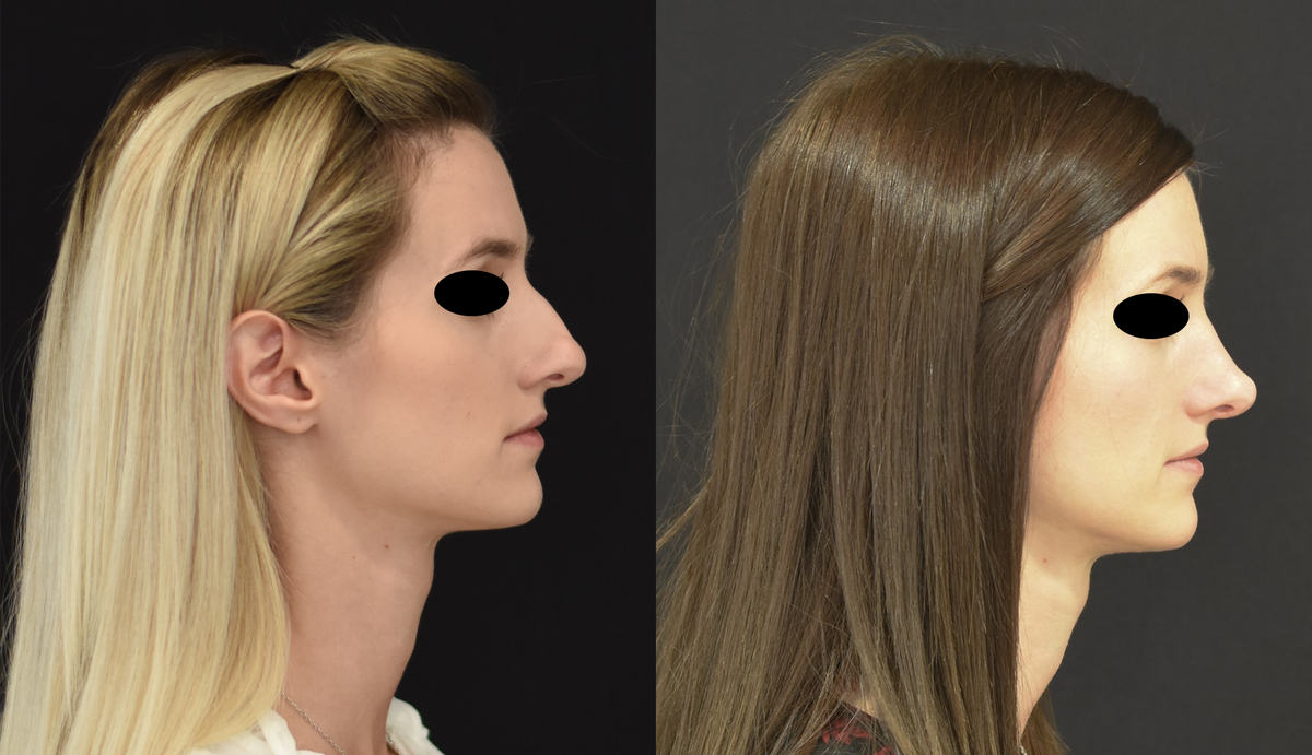 Nose Surgery (Rhinoplasty) Before & After in Cincinnati, Ohio