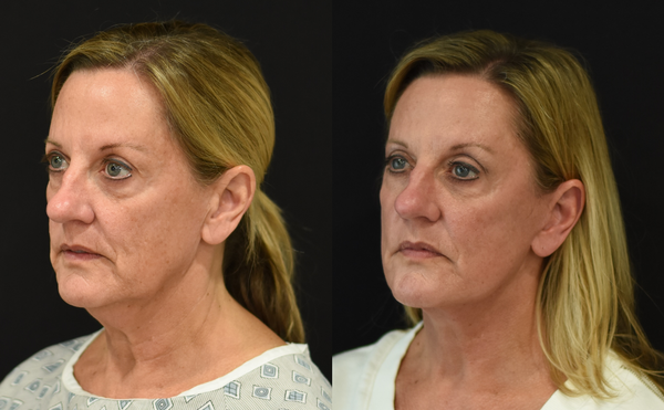 Facelift and Neck Lift Before and After in Cincinnati, Ohio