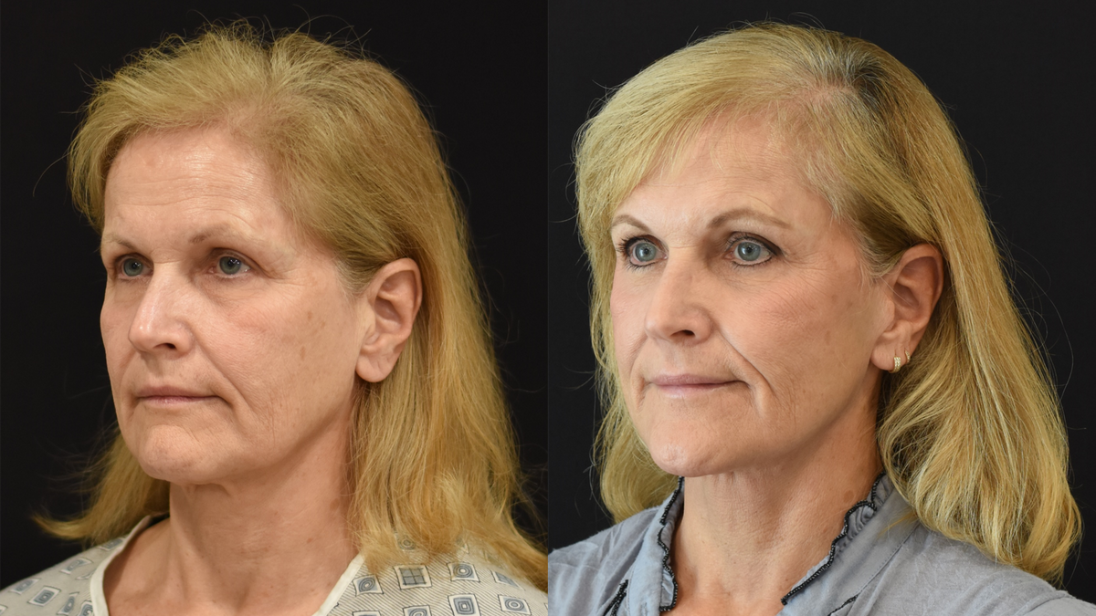 Facelift, Neck Lift, Brow Lift, Upper Eyelid (Blepharoplasty) Surgery, Lower Eyelid Skin Pinch Procedure Before & After in Cincinnati, Ohio