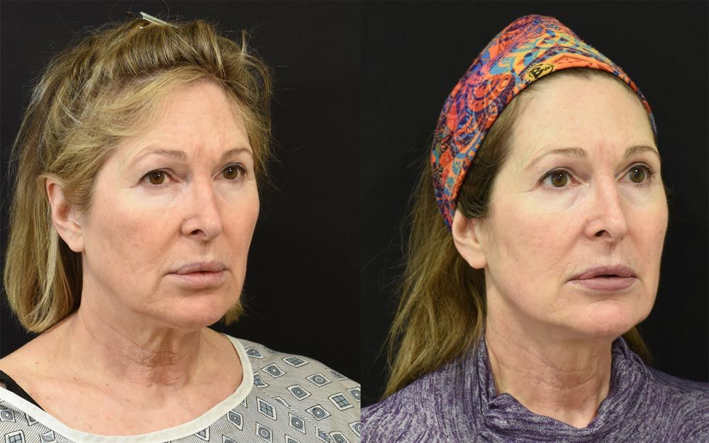 Cincinnati Extended Deep PLane Facelift, Neck Lift, Brow Lift, Eyelid Surgery Before and After - Three Quarter - Optimized