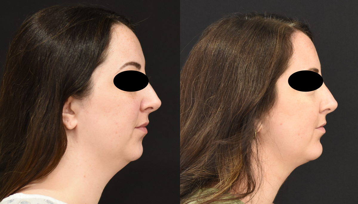 Chin Implant Before and After.png
