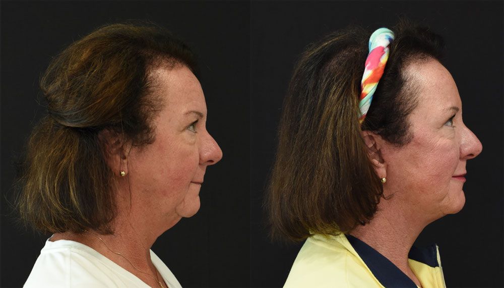 Extended Deep Plane Facelift in Cincinnati - Before and After Side