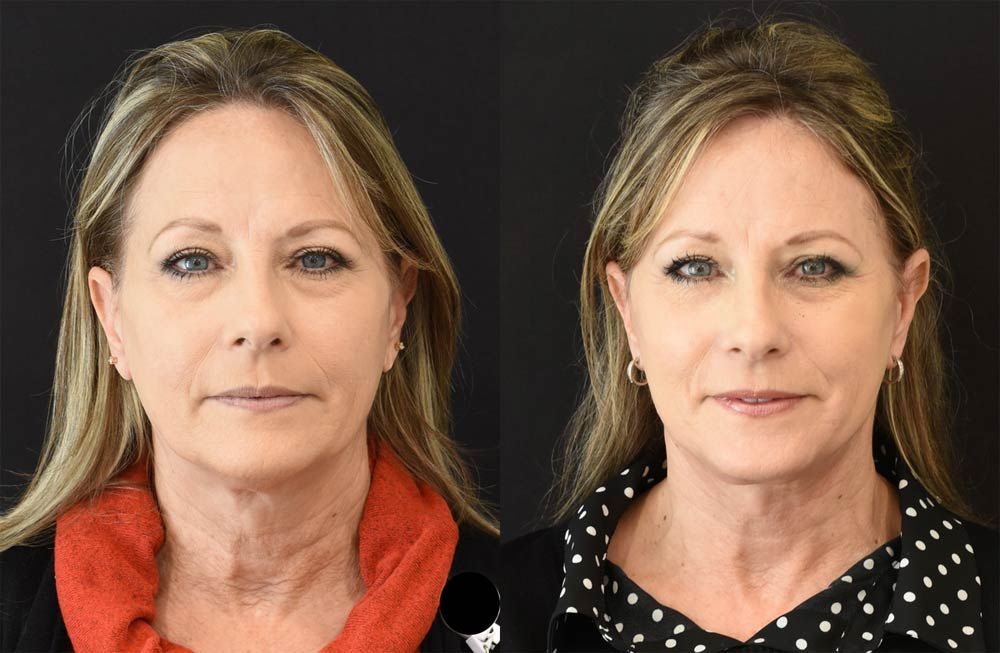 extended deep plane facelif, neck lift, brow lift (front) (optimized)