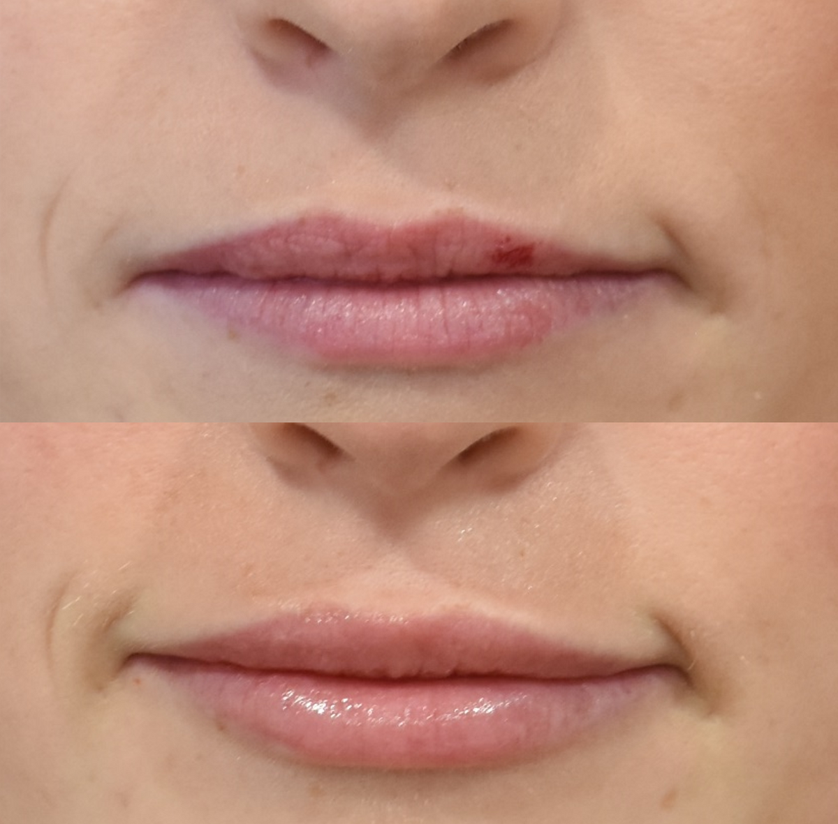 Lip Filler Before and After in Cincinnati, Ohio